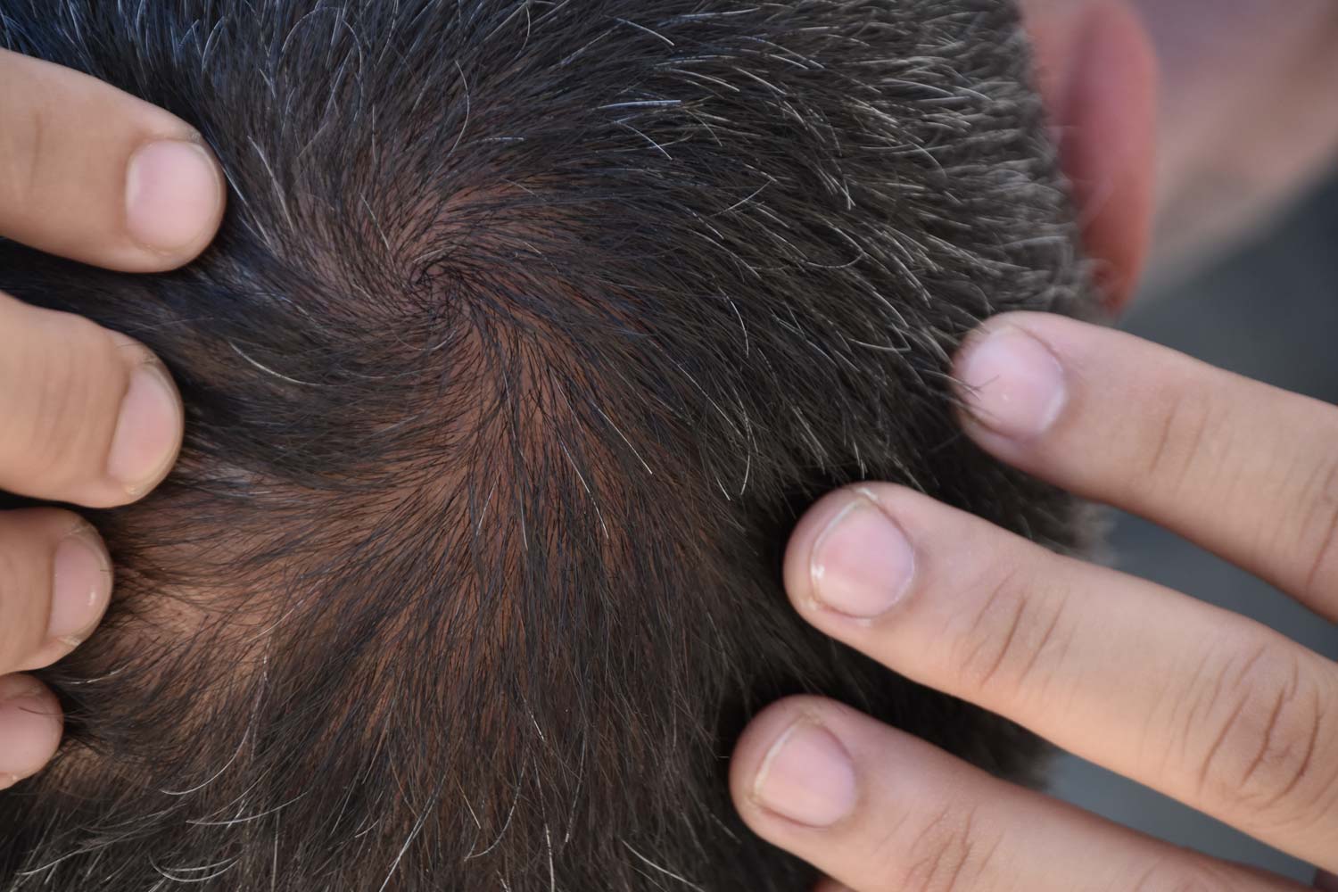 Minoxidil Nebenwirkungen